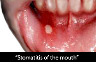 mouth ulcer