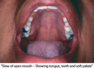 Close-up of inside of mouth