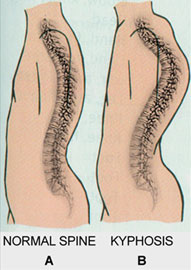 normal and abnormal posture