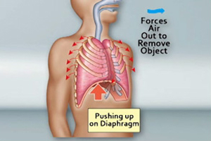 a diagram of the Heimlich maneuver