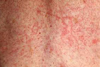 a skin rash