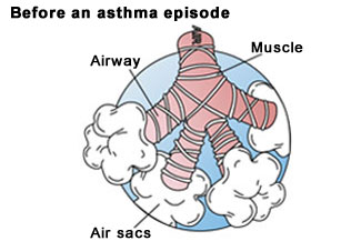 Before an asthma episode