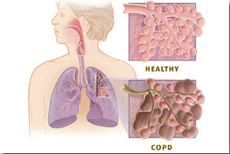 Lung air spaces compared to normal