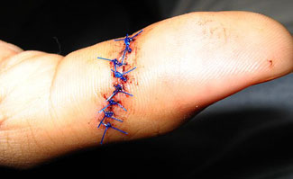 finger with sutures