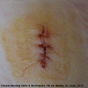 a wound healing