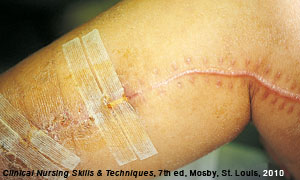 a wound healing