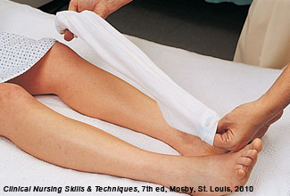 applying an elastic stocking